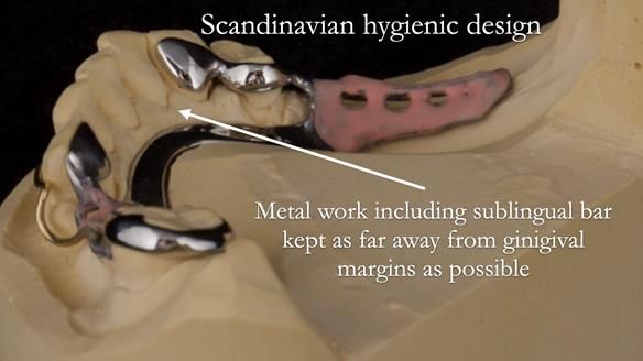 Eileen's transformation with upper and lower RPDs of Scandinavian hygienic design FULL PROTOCOL