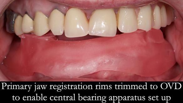 Newsletter 44 - extreme removable prosthodontics – engineering a super-strong and ultra-thin over denture