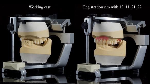 How Keith’s combat denture transformed his life – Newsletter 73