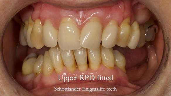 Newsletter 71 Jean’s Class I Mod III RPD: See my mistakes Fractured Mk1 to a Stronger Mk2 RPD (4 years on)