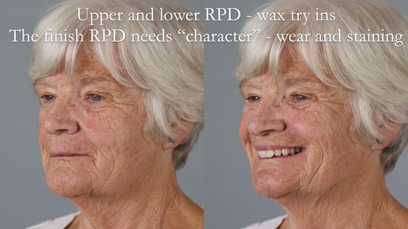 Eileen's transformation with upper and lower RPDs of Scandinavian hygienic design FULL PROTOCOL