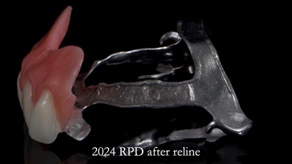 Newsletter 66 Long term case study. Life changing metal based RPD made for Anna