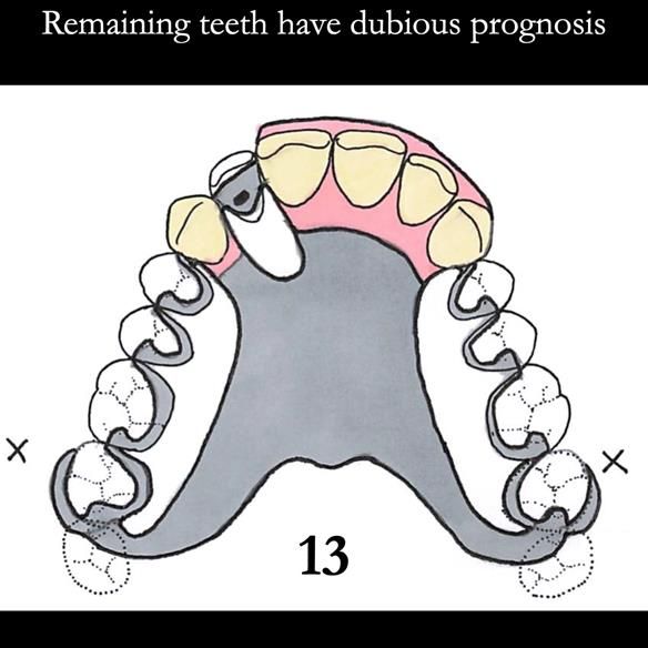 Universal Scandinavian partial denture designs