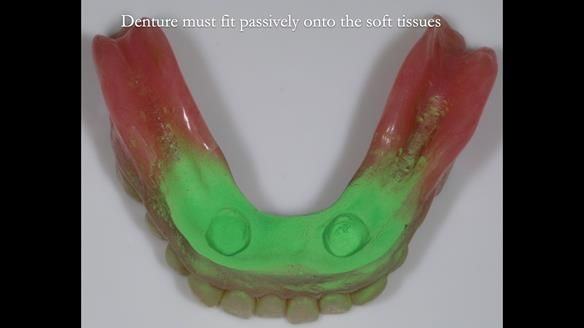 Newsletter 70 Complete Denture Treatment for Kate: A Case Study on Natural-Looking Dentures and Implant-Supported Overdentures