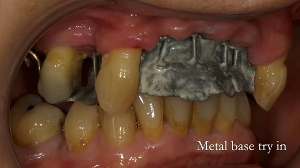 Newsletter 71 Jean’s Class I Mod III RPD: See my mistakes Fractured Mk1 to a Stronger Mk2 RPD (4 years on)