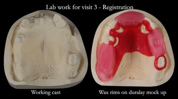 Managing Edgar “THE SCEPTIC” with an RPD/Splint FULL CASE