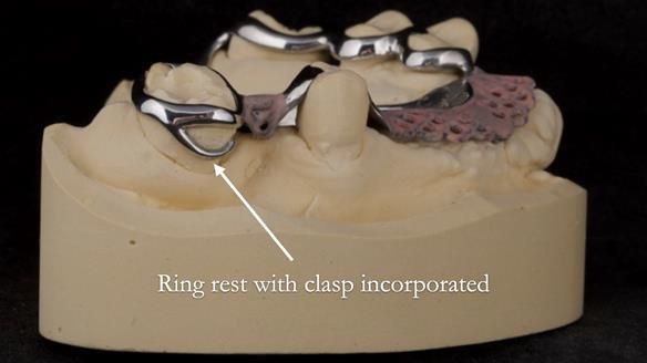 Eileen's transformation with upper and lower RPDs of Scandinavian hygienic design FULL PROTOCOL