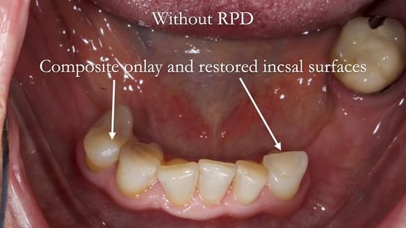 Eileen's transformation with upper and lower RPDs of Scandinavian hygienic design FULL PROTOCOL