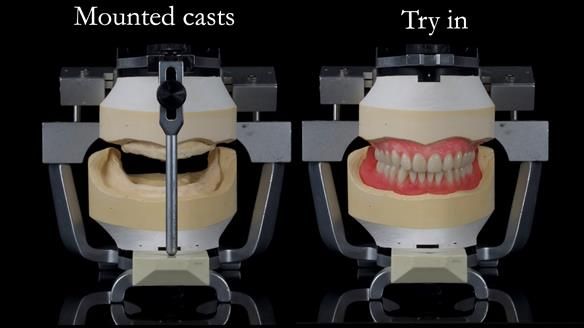 Newsletter 70 Complete Denture Treatment for Kate: A Case Study on Natural-Looking Dentures and Implant-Supported Overdentures