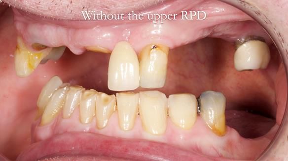 Managing Edgar “THE SCEPTIC” with an RPD/Splint FULL CASE