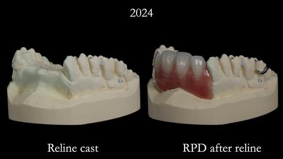 Newsletter 66 Long term case study. Life changing metal based RPD made for Anna