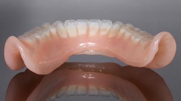 Newsletter 70 Complete Denture Treatment for Kate: A Case Study on Natural-Looking Dentures and Implant-Supported Overdentures