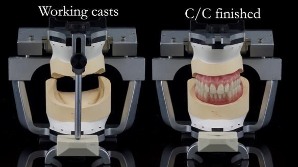 Replacing Madeline’s Complete denture FULL PROTOCOL