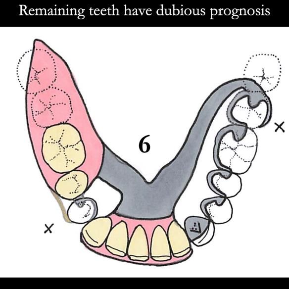 Universal Scandinavian partial denture designs