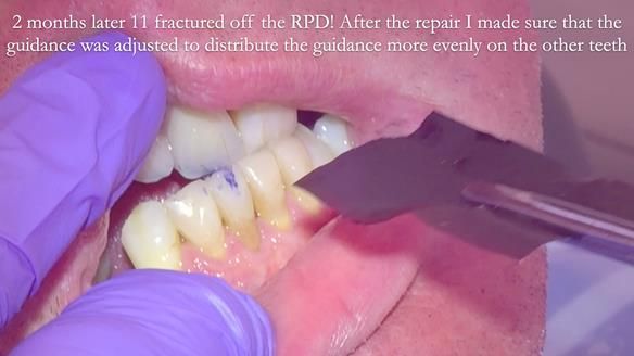 Read Newsletter 67 - Brian's COMBAT DENTURE Case Study