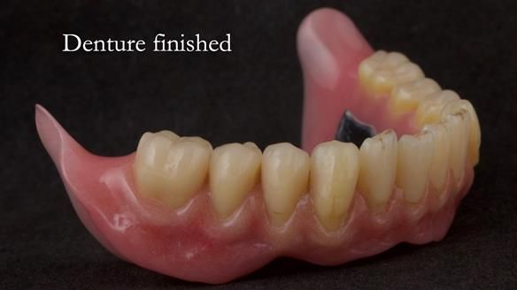 Newsletter 74: Ken’s Case Study Complete Dentures - Life Like and Age Appropriate