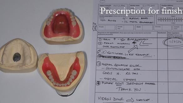 Newsletter 70 Complete Denture Treatment for Kate: A Case Study on Natural-Looking Dentures and Implant-Supported Overdentures