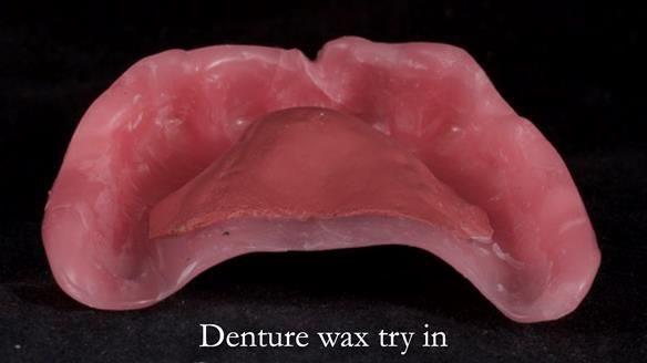 Newsletter 65 Marisa Provision of Complete Dentures on badly placed implants