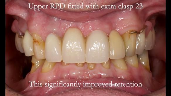 Managing Edgar “THE SCEPTIC” with an RPD/Splint FULL CASE