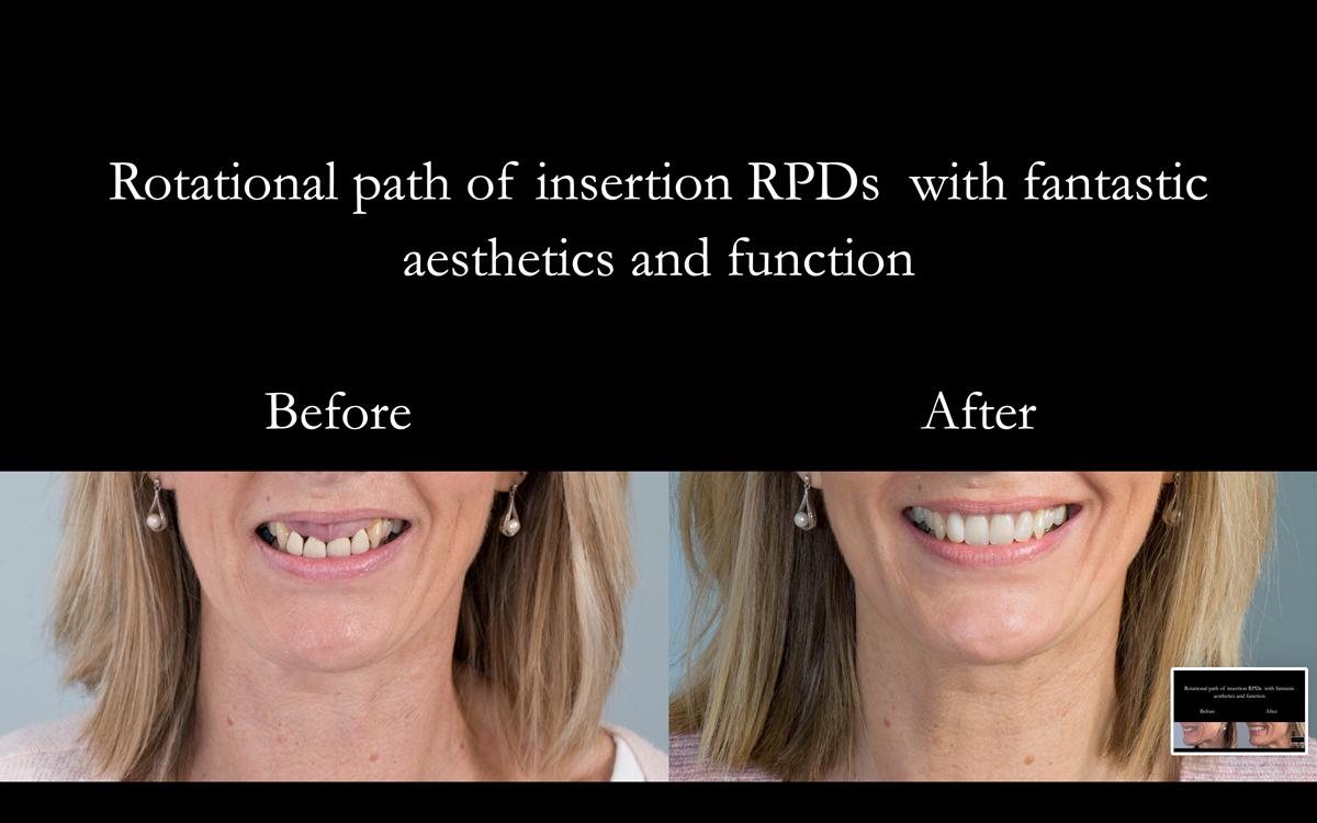  Figure 87 Before and after photos with cobalt chromium based partial dentures with Schottlander Enigmalife teeth