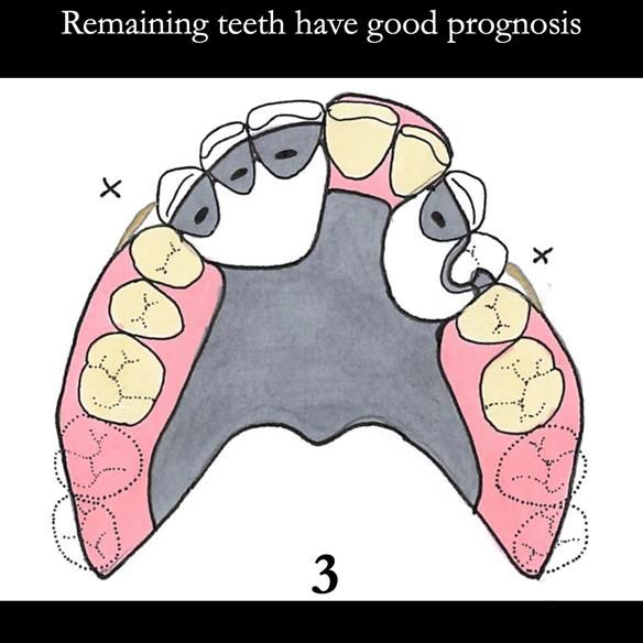 Universal Scandinavian partial denture designs