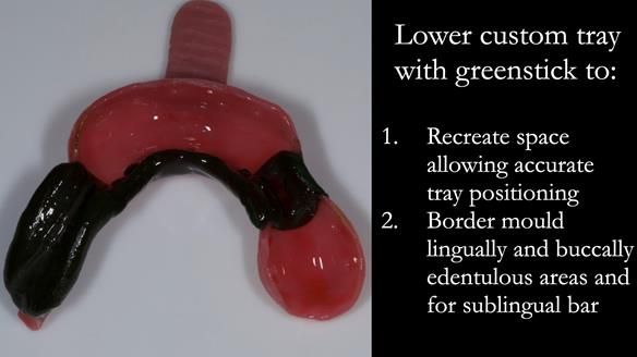 Eileen's transformation with upper and lower RPDs of Scandinavian hygienic design FULL PROTOCOL