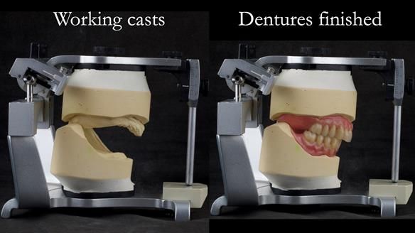 Newsletter 74: Ken’s Case Study Complete Dentures - Life Like and Age Appropriate