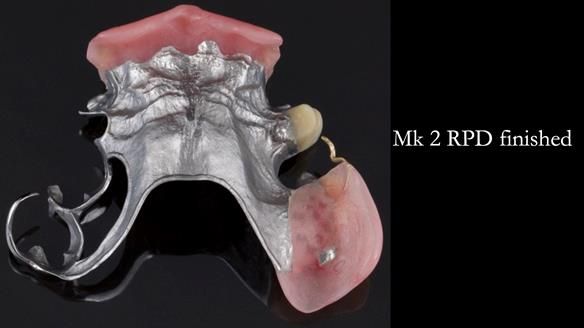 Newsletter 71 Jean’s Class I Mod III RPD: See my mistakes Fractured Mk1 to a Stronger Mk2 RPD (4 years on)