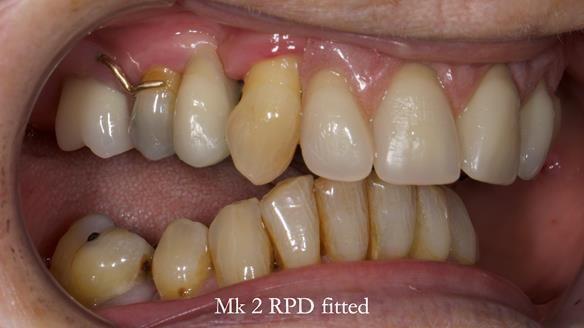 Newsletter 71 Jean’s Class I Mod III RPD: See my mistakes Fractured Mk1 to a Stronger Mk2 RPD (4 years on)