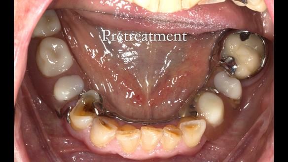 Eileen's transformation with upper and lower RPDs of Scandinavian hygienic design FULL PROTOCOL