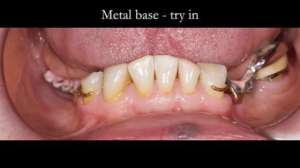 Eileen's transformation with upper and lower RPDs of Scandinavian hygienic design FULL PROTOCOL