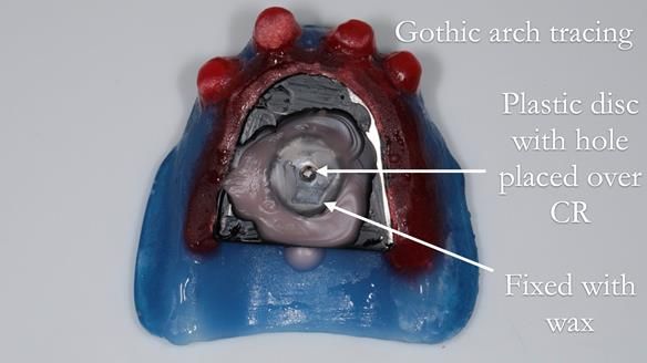 Newsletter 65 Marisa Provision of Complete Dentures on badly placed implants