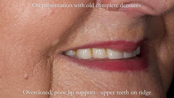 Newsletter 68 Restoring Jan’s Smile: Complete Dentures Inspired by Her Daughter’s Teeth - Post Mouth Surgery