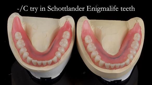 Newsletter 44 - extreme removable prosthodontics – engineering a super-strong and ultra-thin over denture