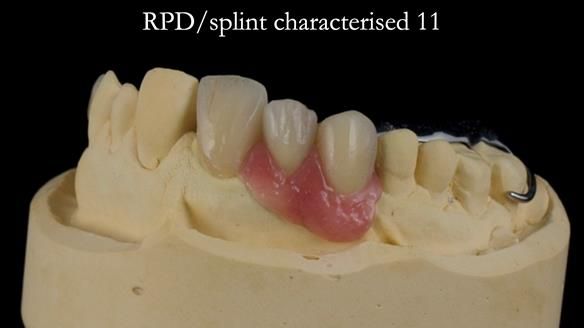 Read Newsletter 67 - Brian's COMBAT DENTURE Case Study