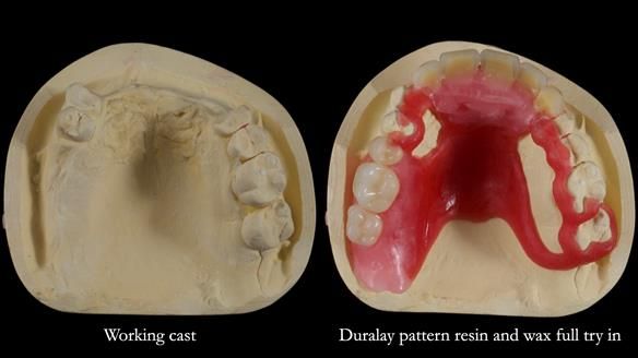 How Keith’s combat denture transformed his life – Newsletter 73