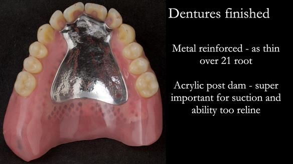 Newsletter 74: Ken’s Case Study Complete Dentures - Life Like and Age Appropriate