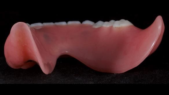 Newsletter 65 Marisa Provision of Complete Dentures on badly placed implants