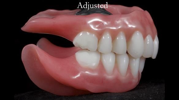 Newsletter 65 Marisa Provision of Complete Dentures on badly placed implants