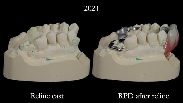 Newsletter 66 Long term case study. Life changing metal based RPD made for Anna