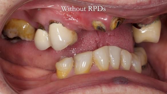 Eileen's transformation with upper and lower RPDs of Scandinavian hygienic design FULL PROTOCOL