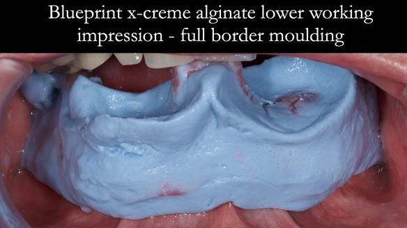 Newsletter 44 - extreme removable prosthodontics – engineering a super-strong and ultra-thin over denture