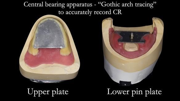 Replacing Madeline’s Complete denture FULL PROTOCOL