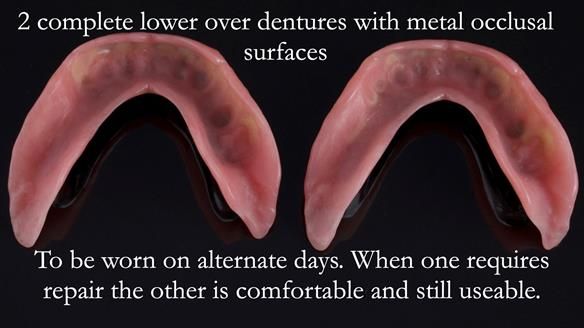 Newsletter 44 - extreme removable prosthodontics – engineering a super-strong and ultra-thin over denture