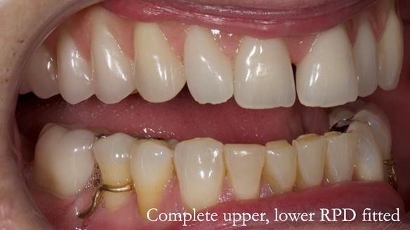 Solving Linda’s Failed “All on 4” implant bridges - full protocol Newsletter 42