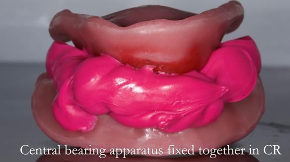 Replacing Madeline’s Complete denture FULL PROTOCOL