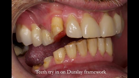 How Keith’s combat denture transformed his life – Newsletter 73