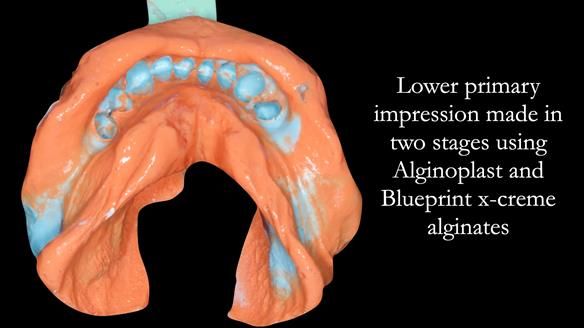 Solving Linda’s Failed “All on 4” implant bridges - full protocol Newsletter 42