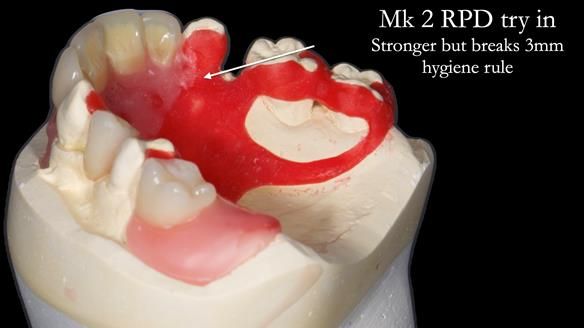 Newsletter 71 Jean’s Class I Mod III RPD: See my mistakes Fractured Mk1 to a Stronger Mk2 RPD (4 years on)