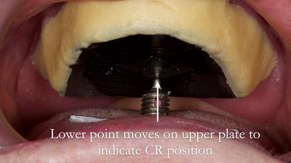 Replacing Madeline’s Complete denture FULL PROTOCOL